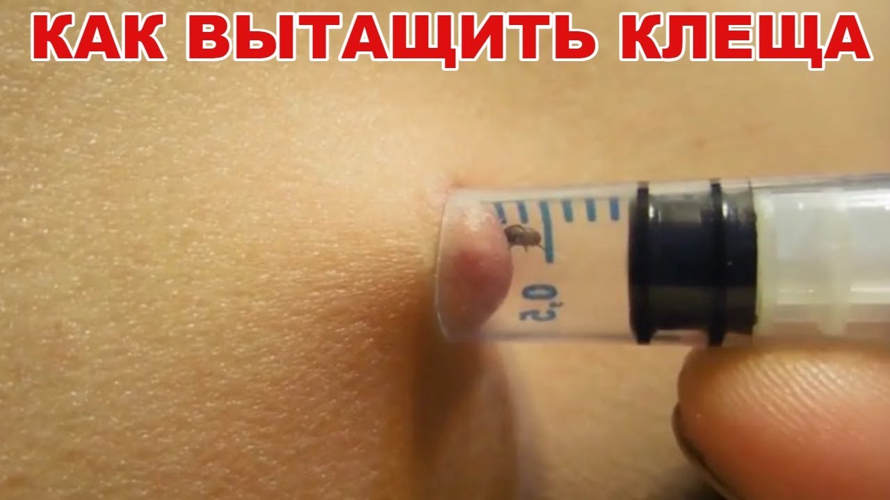 Как вытащить КЛЕЩА шприцом, ПРОСТОЙ, ЭФФЕКТИВНЫЙ способ